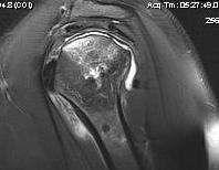 Shoulder AVN MRI Sagittal
